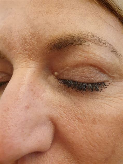 Lower Blepharoplasty Scars