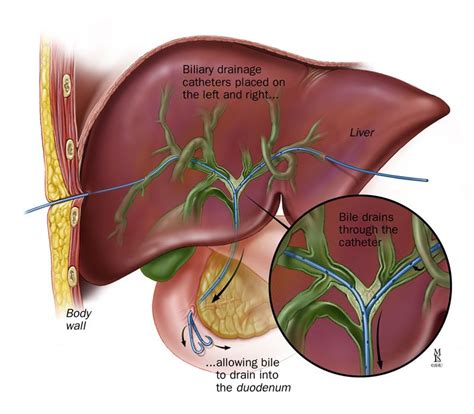 A, point of percutaneous approach on a patient; B, right and left ...