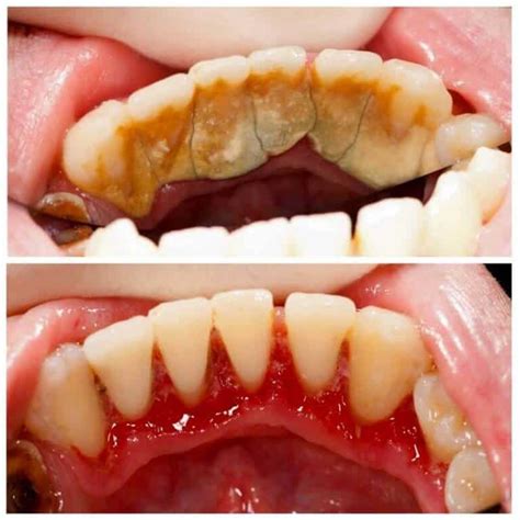 Teeth Cleaning Before and After - Teeth FAQ Blog