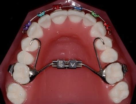 Lower Jaw Expander