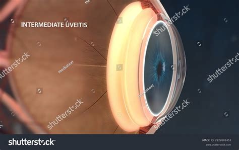 Uveitis Inflammation Part All Uvea Eye Stock Illustration 2222601453 ...