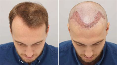 Receding hairline: Causes, Symptoms and Treatment - RepHair