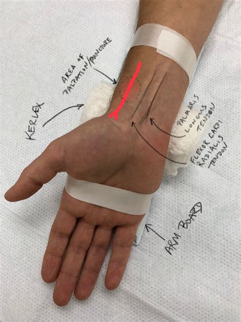 Arterial Line — Taming the SRU