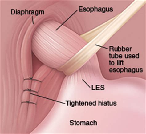 Hiatus (Hiatal) Hernia – Symptoms, Causes, Pictures, Diet and Surgery