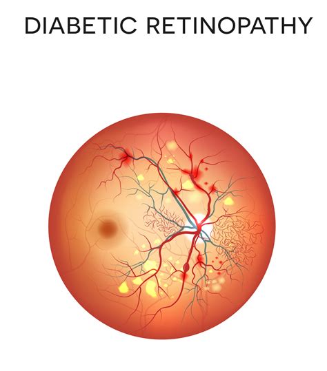 Diabetic Retinopathy - Retina Vitreous Consultants, Inc