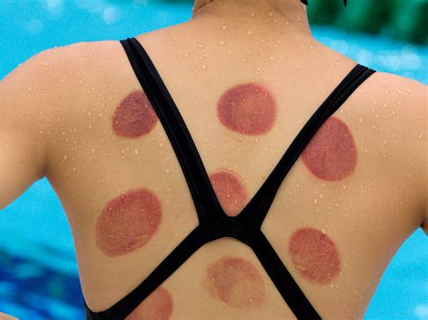 Cupping therapy at the Olympics - Business Insider