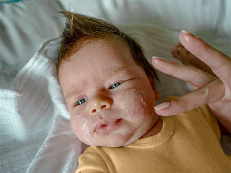 Eczema on Child's Face: Causes, Diagnosis, Treatment, and More