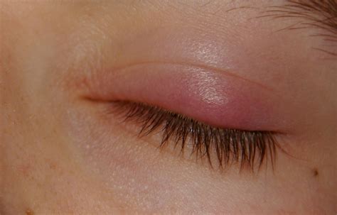 Sty Symptoms: What are the Indications of Eye Stye