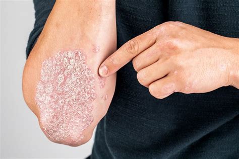 4 Telltale Symptoms of Psoriasis: Balcones Dermatology & Aesthetics ...