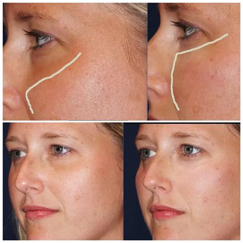 Arriba 92+ Foto Under Eye Filler Before And After Lleno