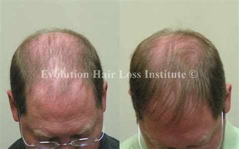 Before and After Hair Growth Treatment Photos