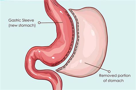 Sleeve Gastrectomy - Wilmington Health