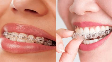 Invisalign Attachments vs. Traditional Braces