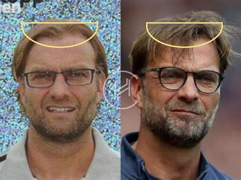 Jurgen Klopp Hair Transplant - Hair Loss & Technical Analysis