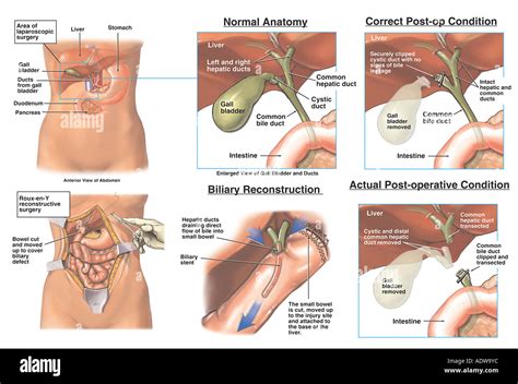 Laparoscopic Cholecystectomy Anatomy