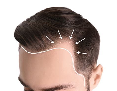 Receding Hairline: Causes, Prevention, Treatment /w Before&After - Estenove