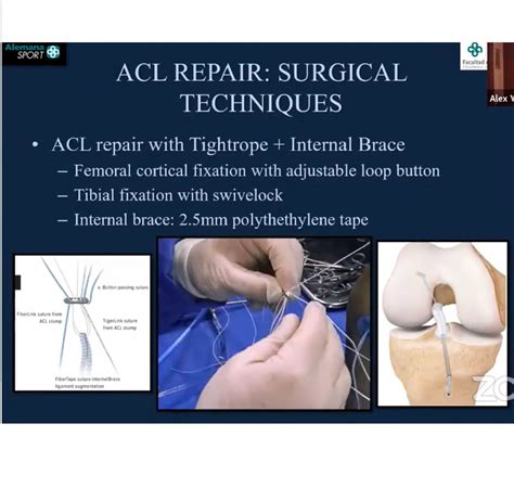 ACL Repair for Femoral Avulsions — OrthopaedicPrinciples.com