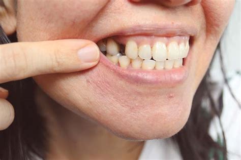 Long-Term Problems Caused by a Missing Tooth - Dental Care Of ...