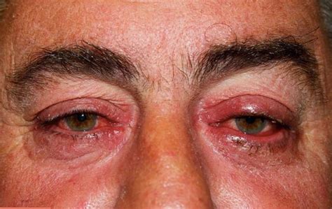 Ocular Rosacea - Causes, Triggers, Symptoms, Eye Drops, Treatment