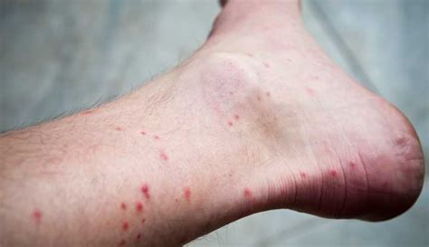 Flea Bites: What They Look Like, Symptoms & Treatment