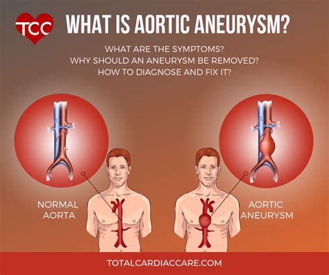 What is Aortic Aneurysm? | Total Cardiac Care | Dr Mahadevan