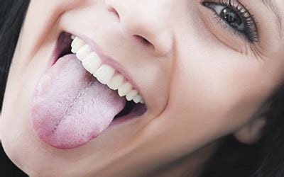 What You Should Know About Geographic Tongue