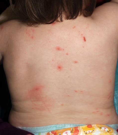 All 102+ Images Skin Rashes On Kids Pictures Latest