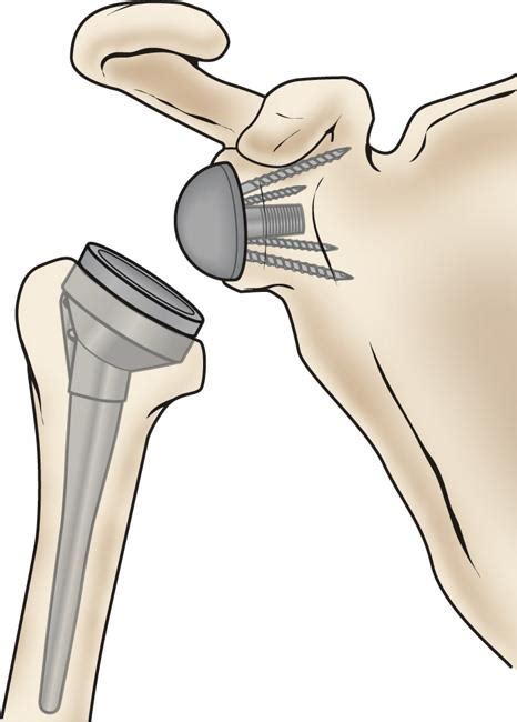 Reverse Total Shoulder Replacement - OrthoInfo - AAOS