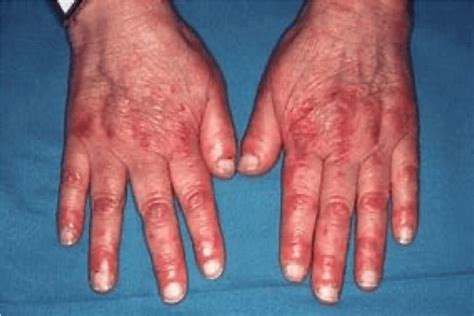 Dermatomyositis signs, symptoms: muscle inflammation & rash