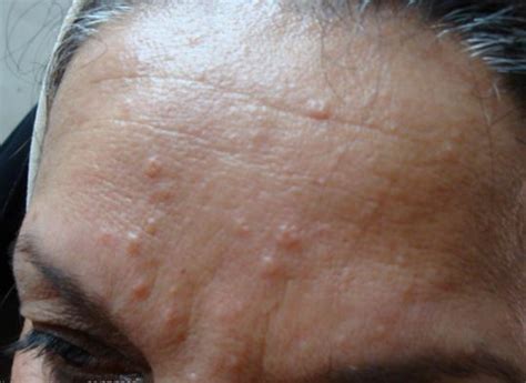 Sebaceous Hyperplasia - Treatment, Photos, Removal, Causes