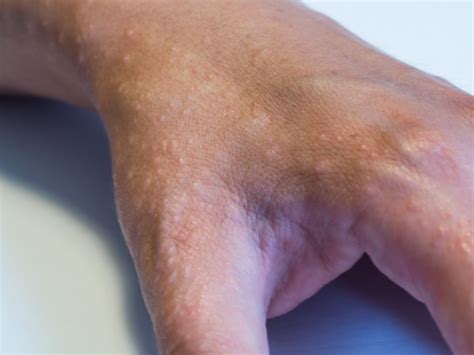 Dyshidrotic Dermatitis: Symptoms, Causes, Diagnosis, and Treatment