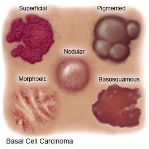 Basal Cell Carcinoma (Inpatient Care)