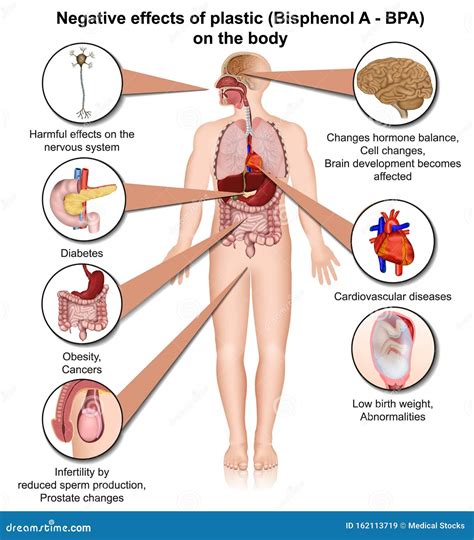 Bisphenol a Effects on the Human Body 3d Medical Vector Illustration ...