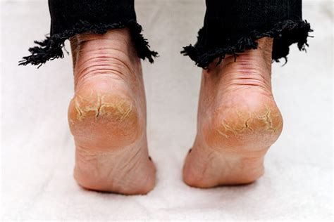 How To Remove Thick Dead Skin From Feet