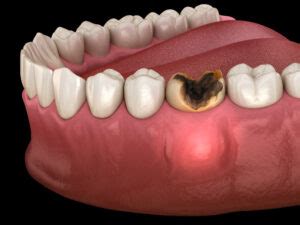 Periostitis tooth - Lump on Gum Above Tooth. Medically accurate dental ...