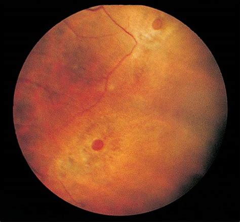 Operculated Retinal Hole In Retinal Detachment Retina