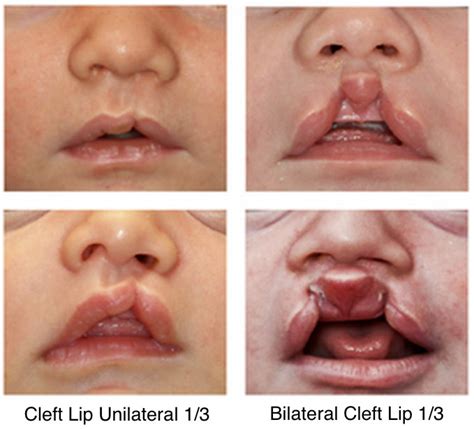 Cleft-lip-and-cleft-palate-one - Dell Children's Craniofacial Team of Texas