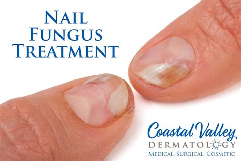 nail removal for toenail fungus - Toenail Fungus Treatment | Toenail ...