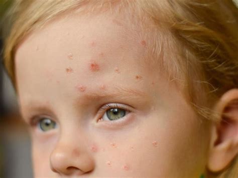 Scarlet fever: Symptoms to look out for and how to treat