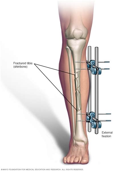 External fixation - Mayo Clinic