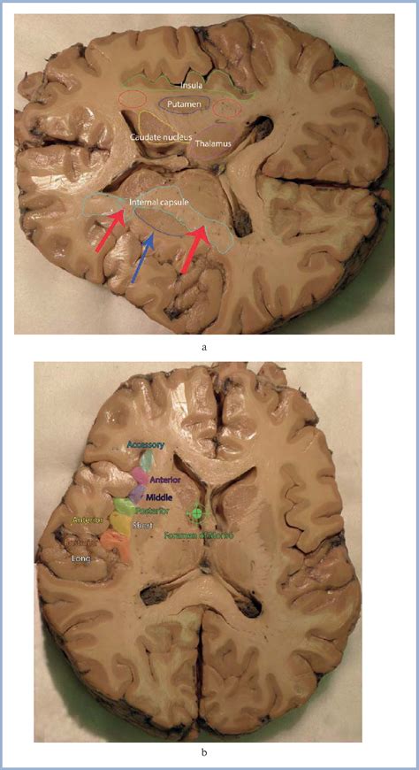 Figure 8 from [Surgical anatomy of the insular cortex]. | Semantic Scholar