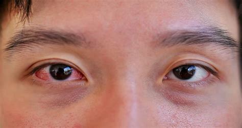 Sore Eyes - Symptoms, Causes, and Treatment