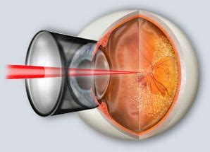 Pan-Retinal Photocoagulation - Pittsburgh, PA & Pittsburgh, PA - North ...