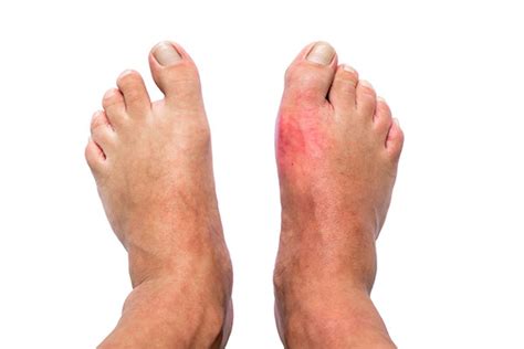 What Is The Fastest Way to Get Rid of Gout? - Dr. Naveen Bhadauria ...