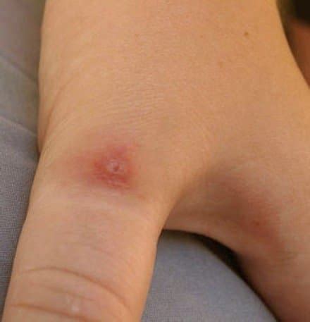 Pictures, Symptoms, and Treatment of Black Widow Spider Bites - HubPages