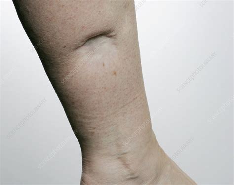 Scar after skin cancer removal - Stock Image - C011/7566 - Science ...