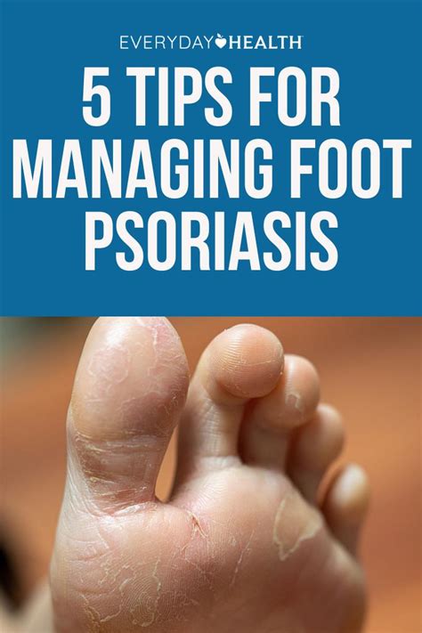 Tips for Managing Foot Psoriasis | Everyday Health in 2021 | Psoriasis ...