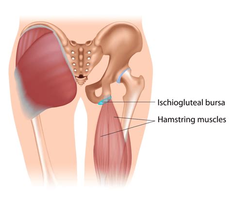 What is Ischial Bursitis & What Symptoms Can You Expect? - Upswing Health