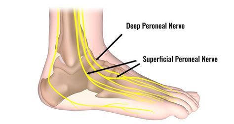 Peroneal Nerve Contusion - Symptoms, Causes, Treatment & Exercises