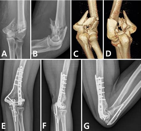 Distal Humerus Fracture: How to Choose the Approach, Implant, Fixation ...